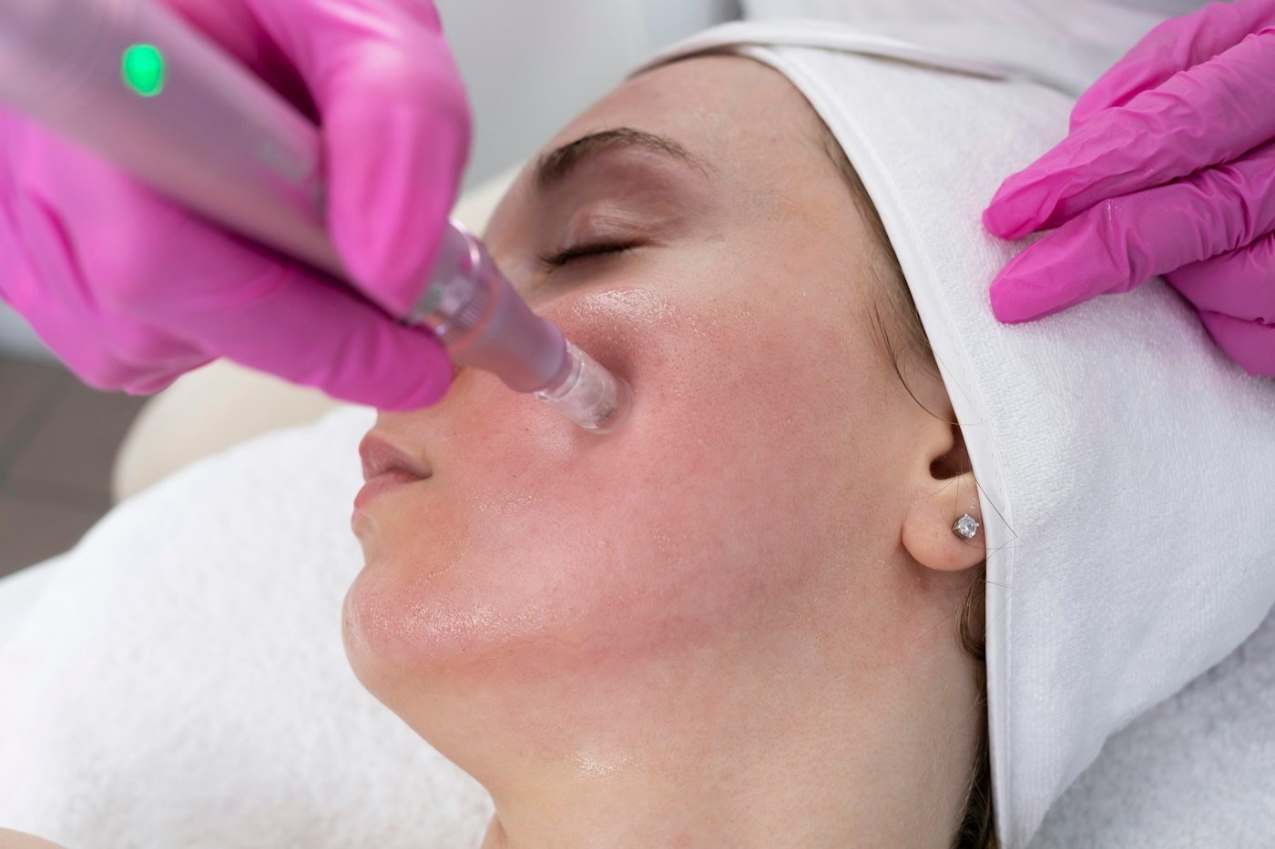 Microagulhamento facial realizado no estúdio em Giruá/RS